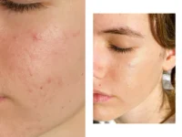 korektor prej potem najboljši rezultat