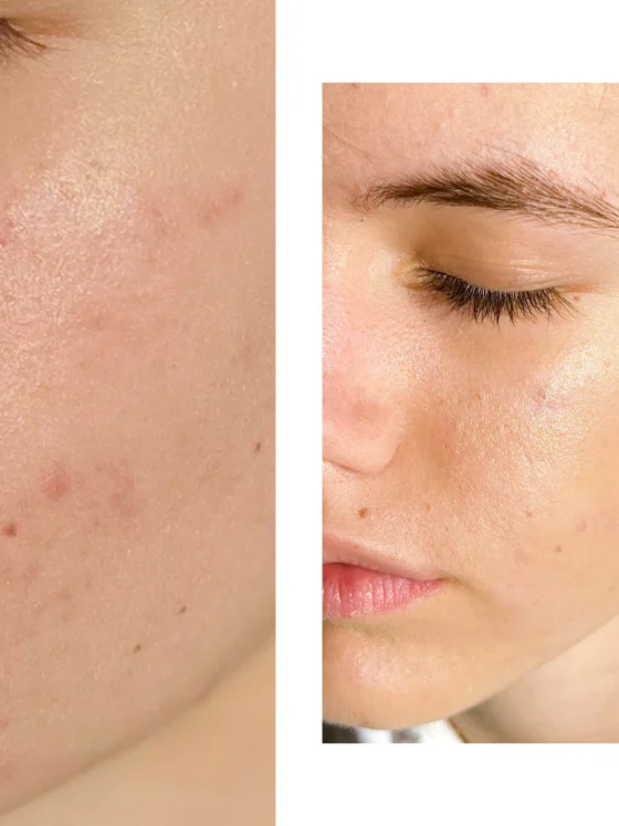 Korektor: vse kar moraš vedeti o tem drugem najbolj prodajanem ličilu