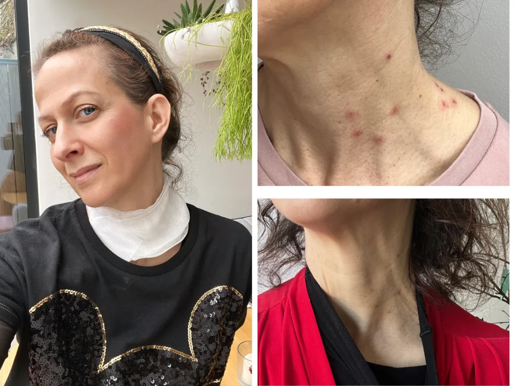 pregled odstranitev znamenj osebna izkušnja nika veger beautyfull blog