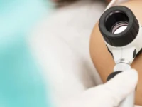 pregled odstranitev znamenj osebna izkušnja nika veger beautyfull blog coolbeanliving