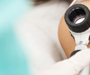 pregled odstranitev znamenj osebna izkušnja nika veger beautyfull blog coolbeanliving